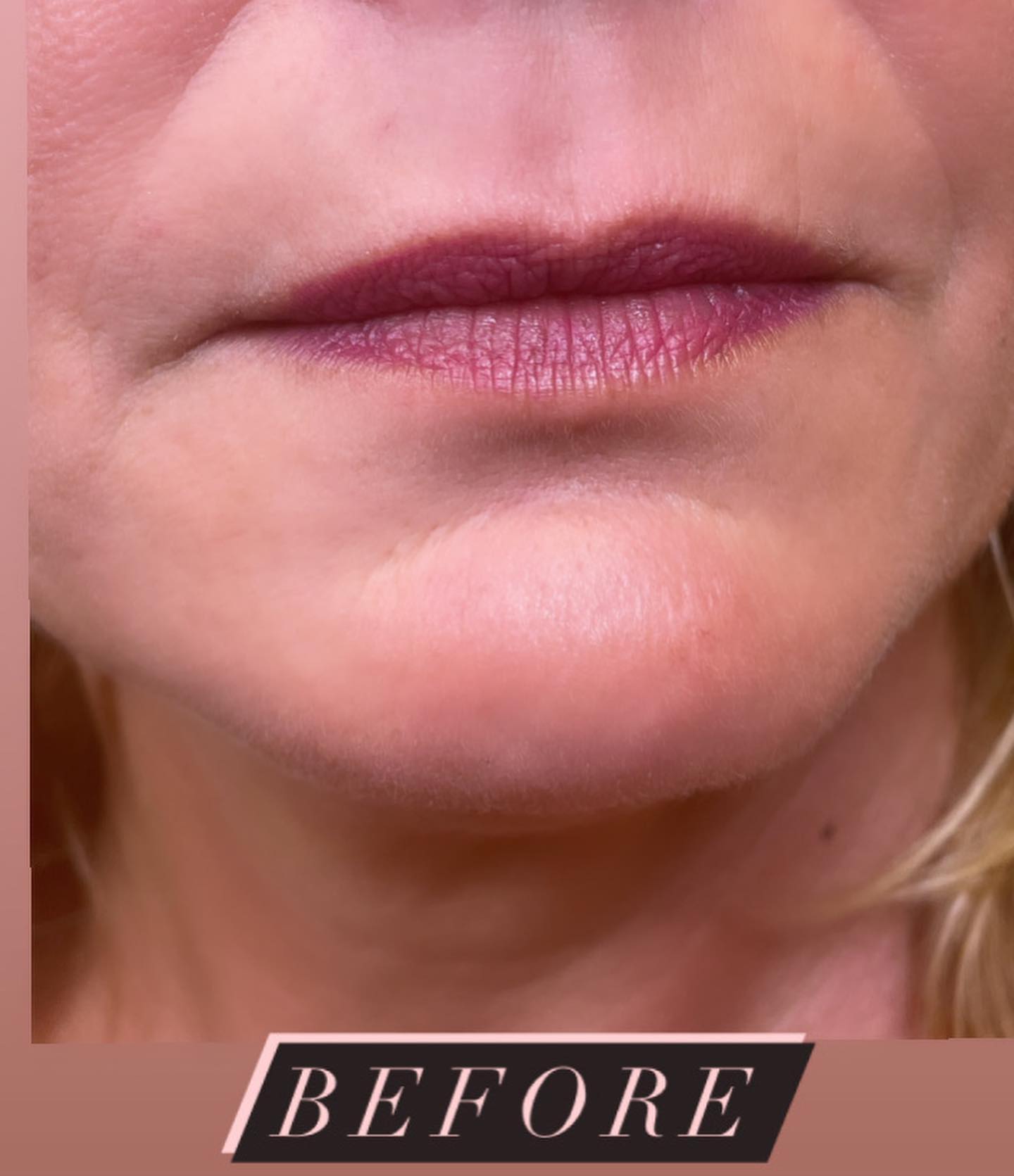 Lips before a half-syringe lip filler treatment
