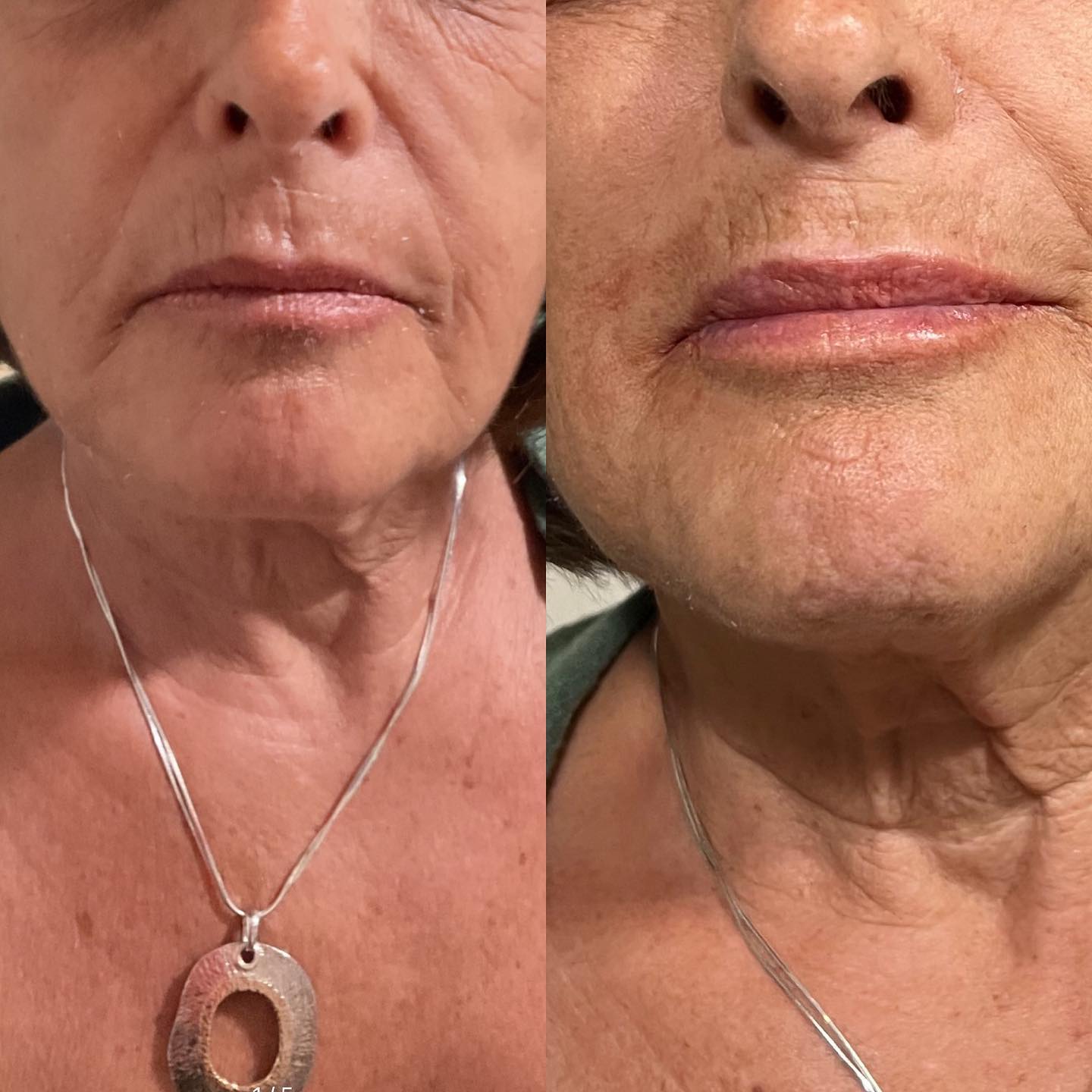 Restylane Kysse lip filler before and after