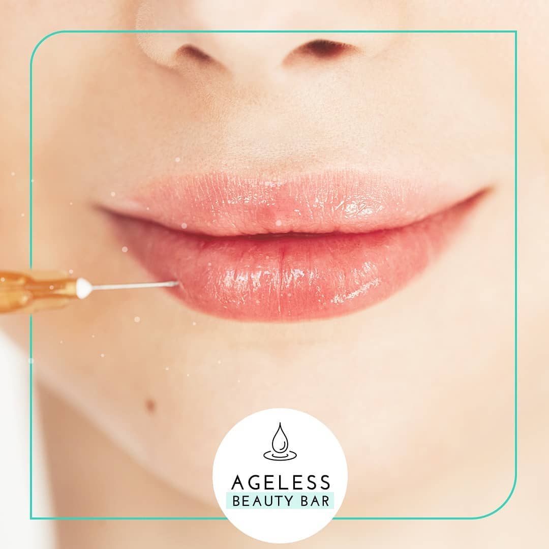 Lip filler treatment result