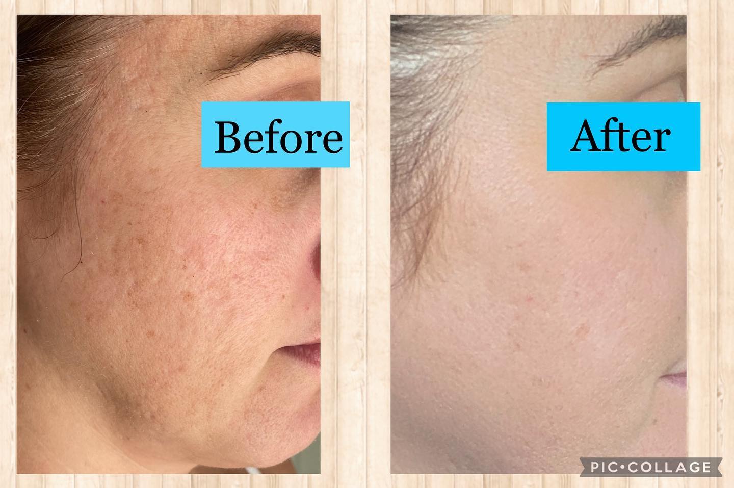 Microneedling with PRP before and after
