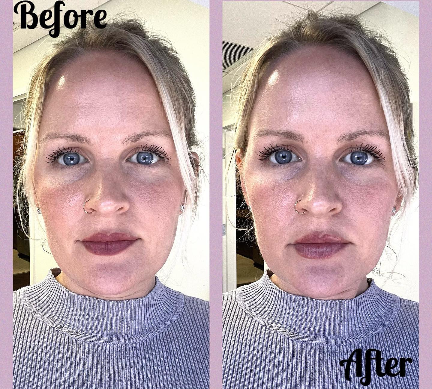 Upneeq before and after eye treatment
